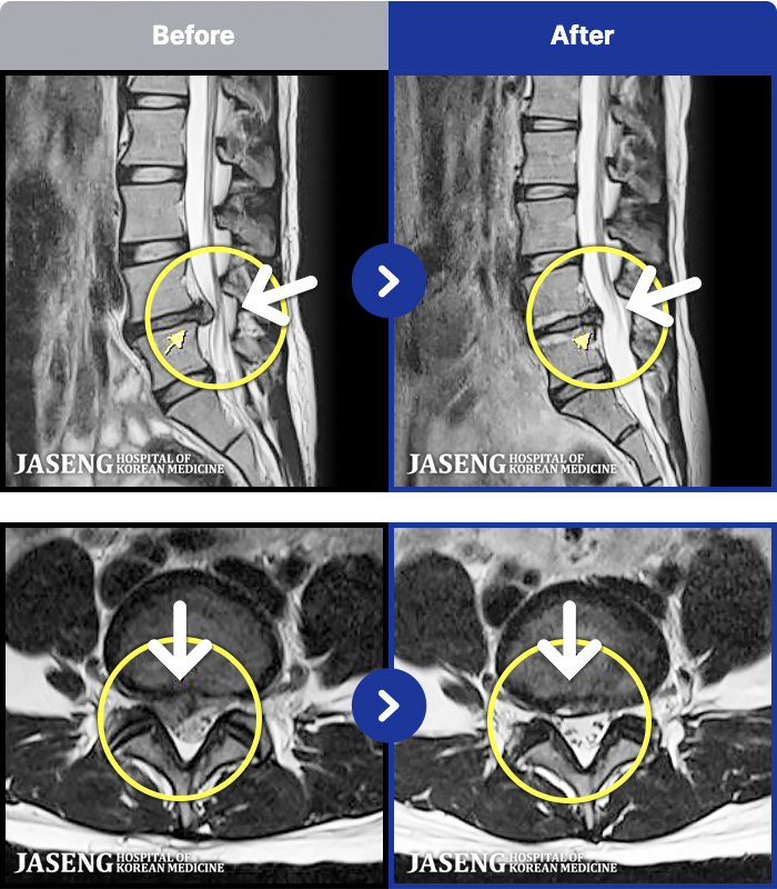 õ���ڻ��ѹ溴�� ġ���� MRI�� ���� ġ����-�� 1�� ���� ���� �ʴ� ���� �㸮���� ���, ������������ �̾����� ���� �� �ɾҴ� �Ͼ �� ���� ��ȭ�Ǿ� �����ϼ̽��ϴ�.