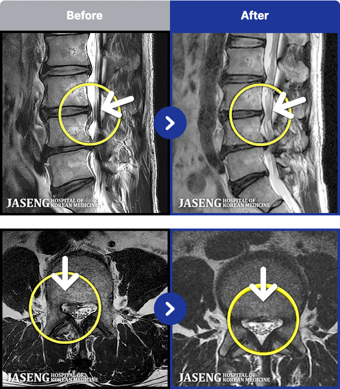 �����ڻ��ѹ溴�� ġ���� MRI�� ���� ġ����-���� �㸮 ������ ���� ����� ���� 