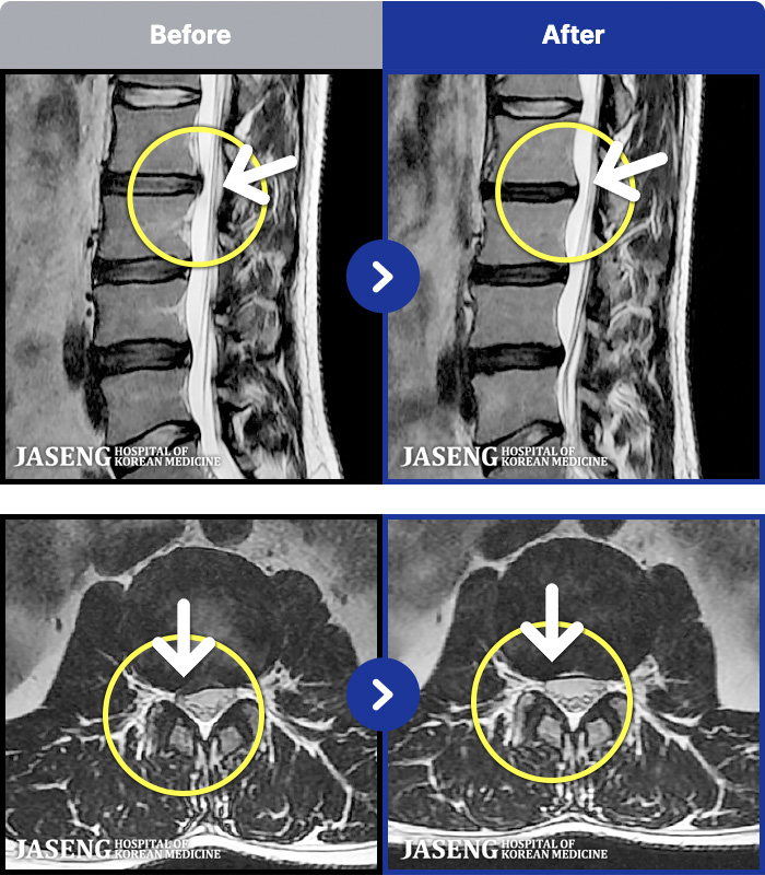 ���ڻ��ѹ溴�� ġ���� MRI�� ���� ġ����-�㸮�������� �ŵ��� �ȵȴ�.