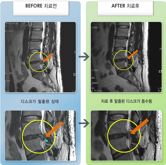 자생한방병원 치료사례 MRI로 보는 치료결과-허리와 오른쪽 다리 통증이 심하여  움직임이 자유롭지 못한 상태