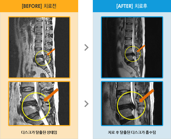 자생한방병원 치료사례 MRI로 보는 치료결과-허리에서 우측 종아리 외측으로 저림
