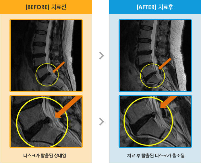 자생한방병원 치료사례 MRI로 보는 치료결과-양쪽 허리 통증 및 우측 다리 경직되고 저림 증상